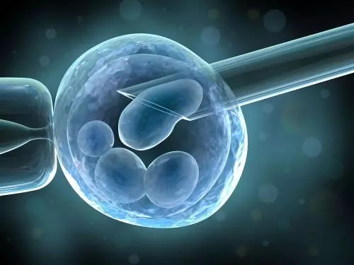 美国IVF无痛取卵的过程