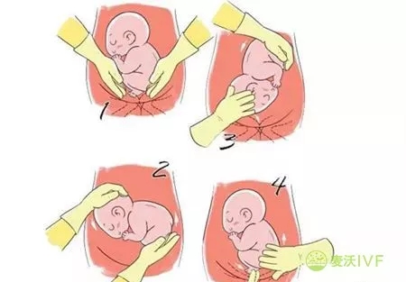 台湾试管婴儿：胎位不正该怎么矫正