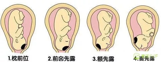 台湾试管婴儿：胎位不正该怎么矫正