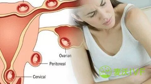 查血HCG能查出宫外孕吗？