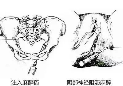 生孩子为什么要侧切？