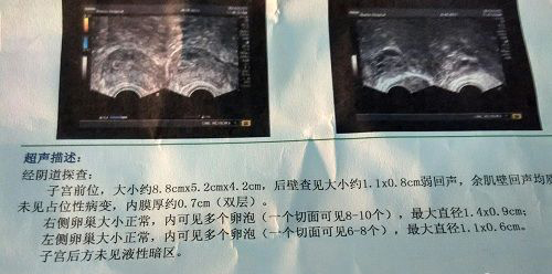 爱之晶海外试管名称解释——卵泡监测