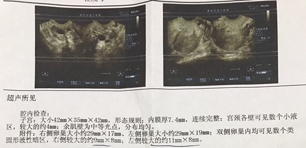 爱之晶海外试管名称解释——排卵监测