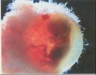 爱之晶：胎儿的染色体会自己变不正常吗？