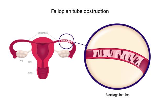 Hello IVF：cd138细胞子宫内膜炎不能做试管？